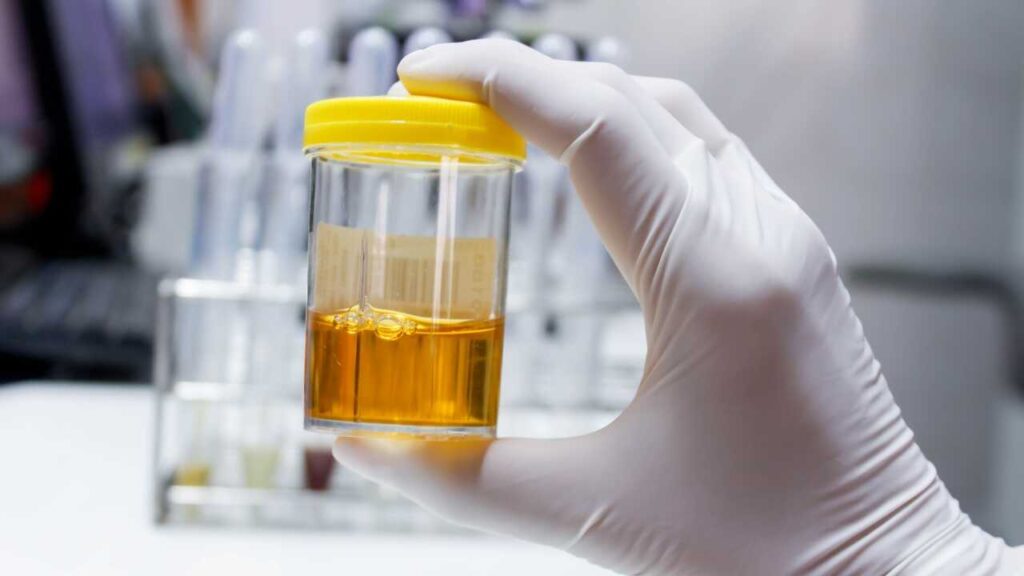 Pipì Arancione: Cause e Soluzioni