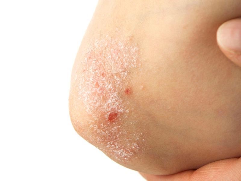 La psoriasi di gomiti e ginocchia