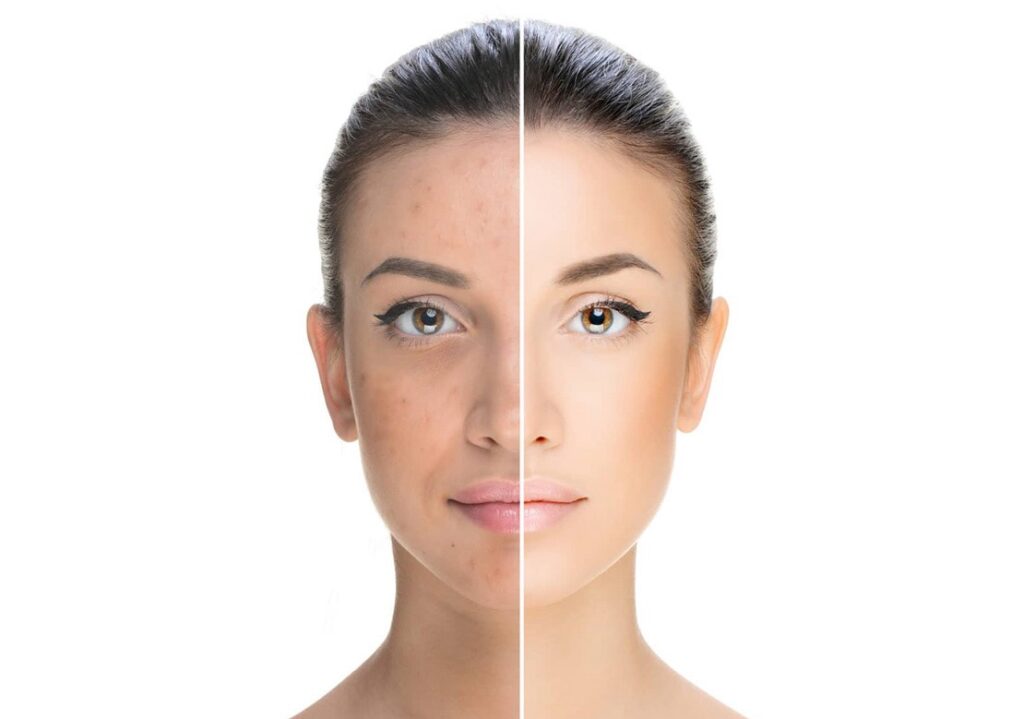 Retinolo e Irritazione: Come Gestire Gli Effetti Collaterali