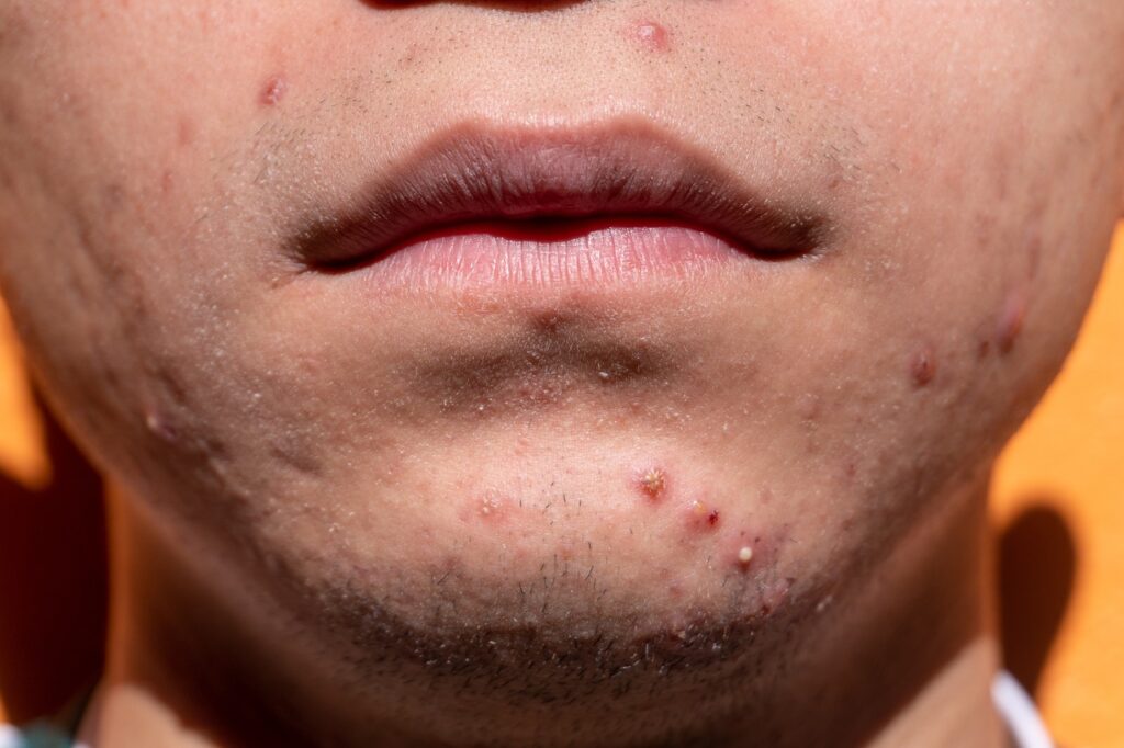 Cura per acne: soluzioni efficaci per una pelle sana