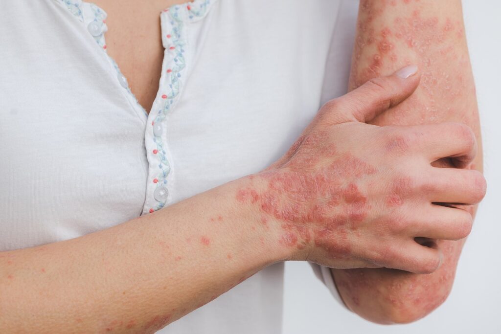 Cura per la psoriasi: soluzioni efficaci per gestire la malattia