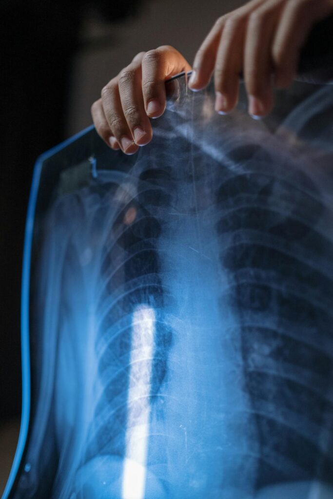 Enfisema ai polmoni: una guida completa
