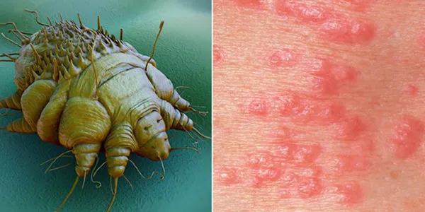 Cosa si rischia con la scabbia?