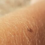 Tumori cutanei: tipologie, cause e prevenzione