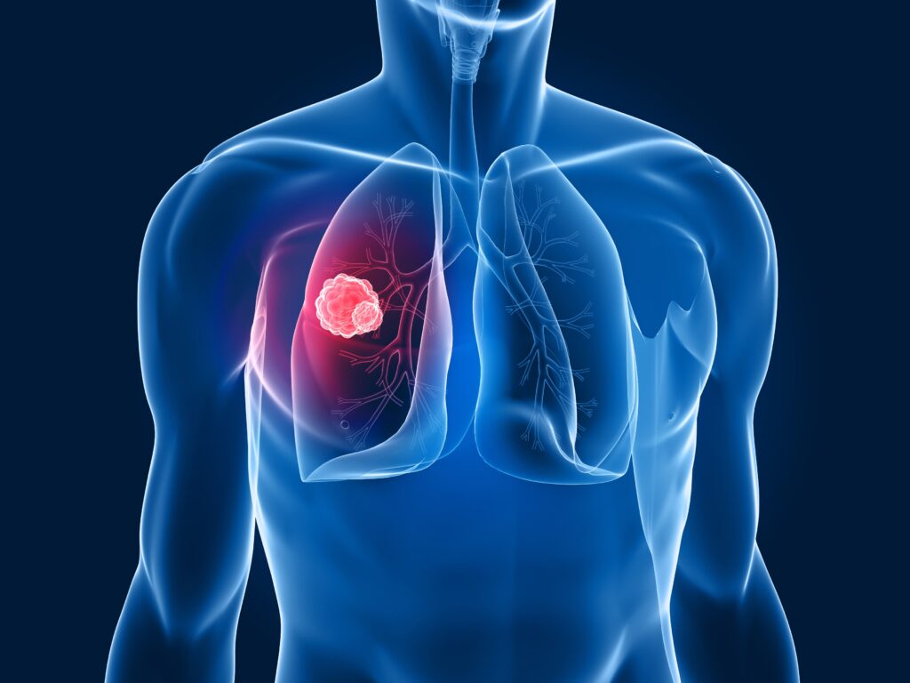Quali sono i campanelli d'allarme per un tumore?