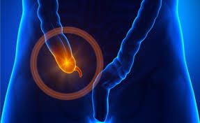 Cosa fa scatenare l'appendicite?