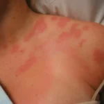 Cosa sono le chiazze rosse sulla pelle?