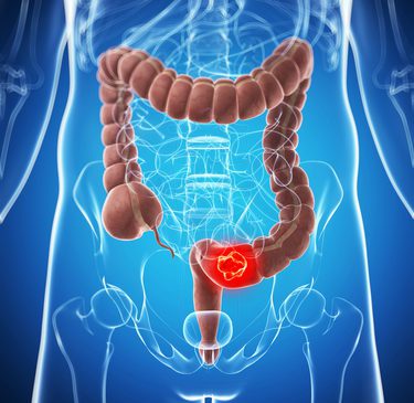 Come guarire dal tumore al colon?