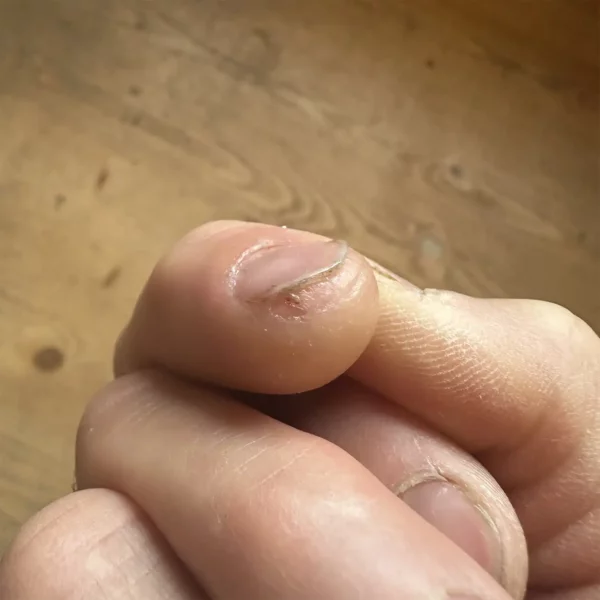 Come curare le crepe alle mani?