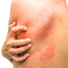 Perché il ghiaccio fa passare il prurito?