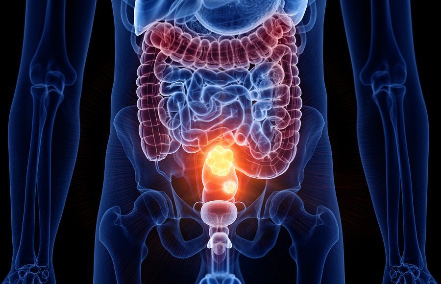 Come escludere un tumore all’intestino?