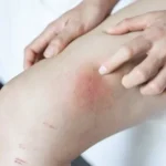 Dove compaiono le macchie da leucemia?