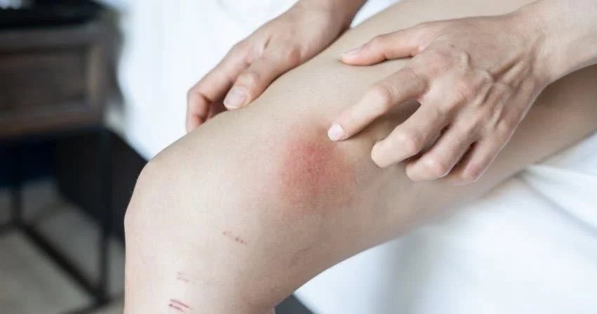 Dove compaiono le macchie da leucemia?