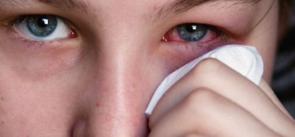 Cosa succede se entra limone negli occhi?