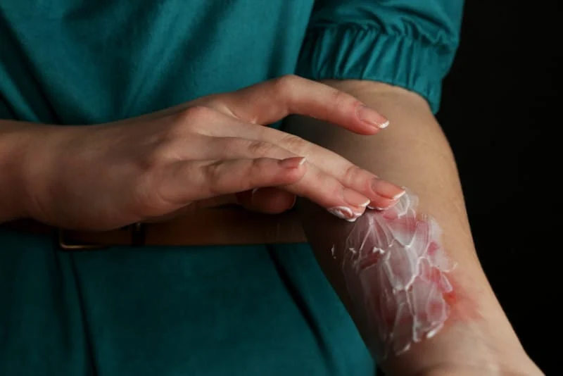 Come schiarire una macchia da bruciatura?