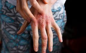 Cosa significa quando si spaccano le mani?