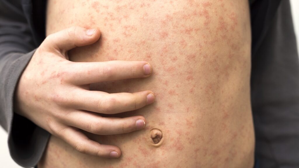 Morbillo negli Adulti: Sintomi, Complicazioni e Prevenzione