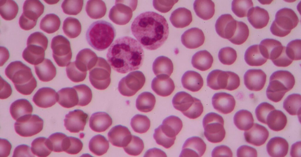 Quali organi colpisce la leucemia?