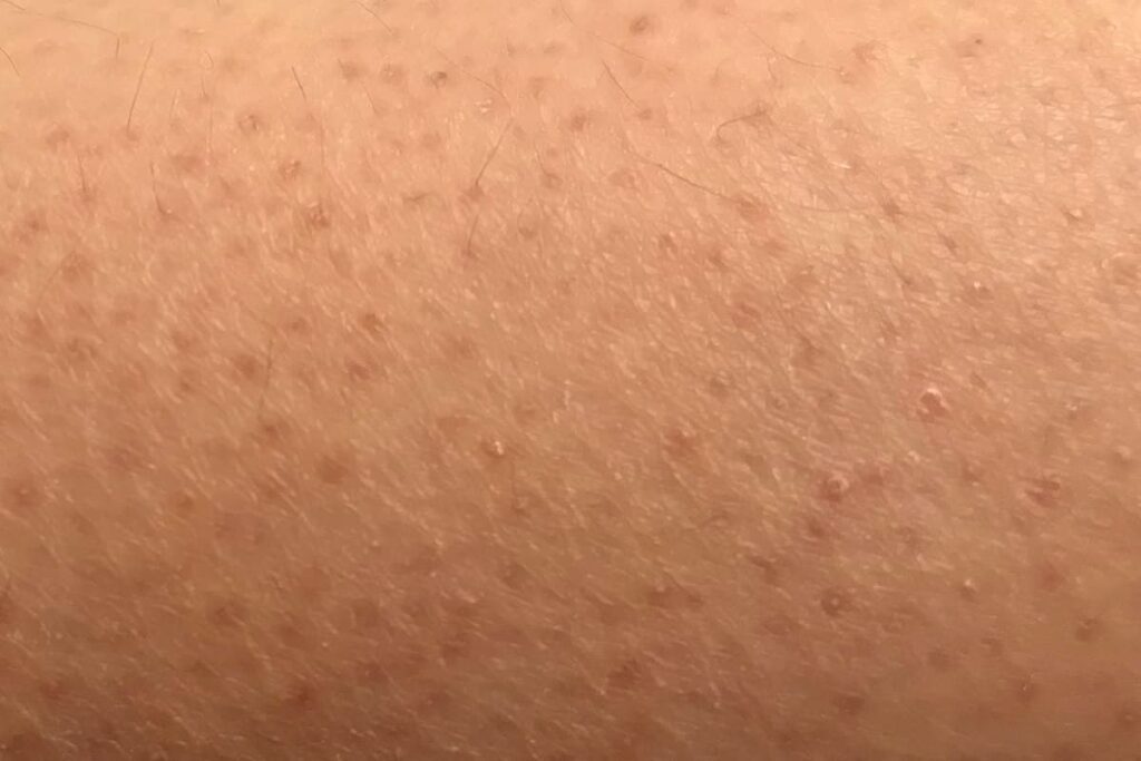 Perché si ha la pelle ruvida?