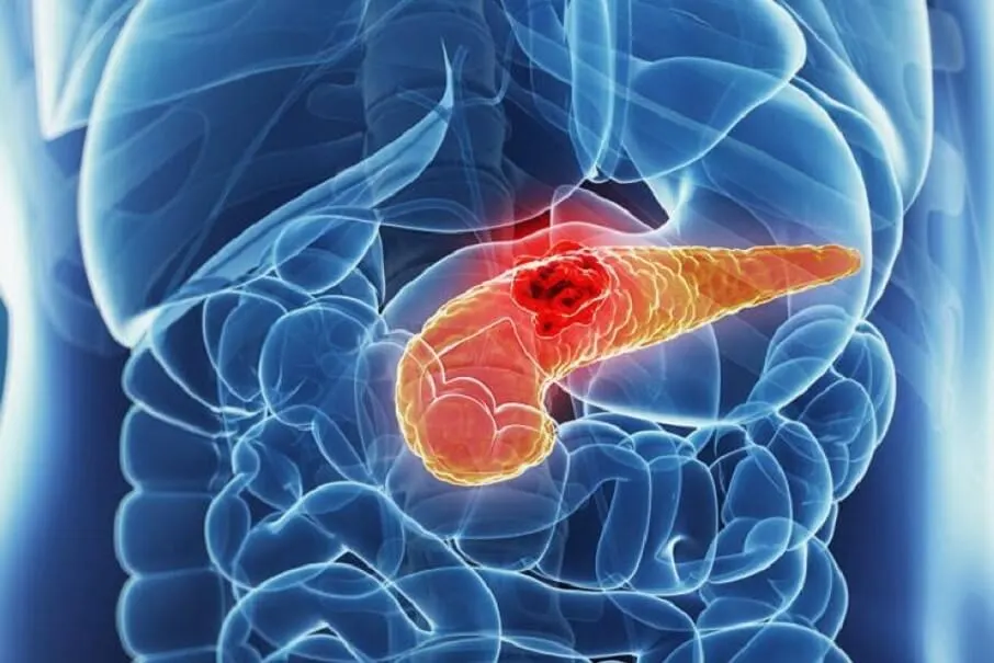 Come ci si accorge di avere problemi al pancreas?