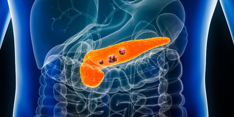 Cosa succede se il pancreas non funziona?