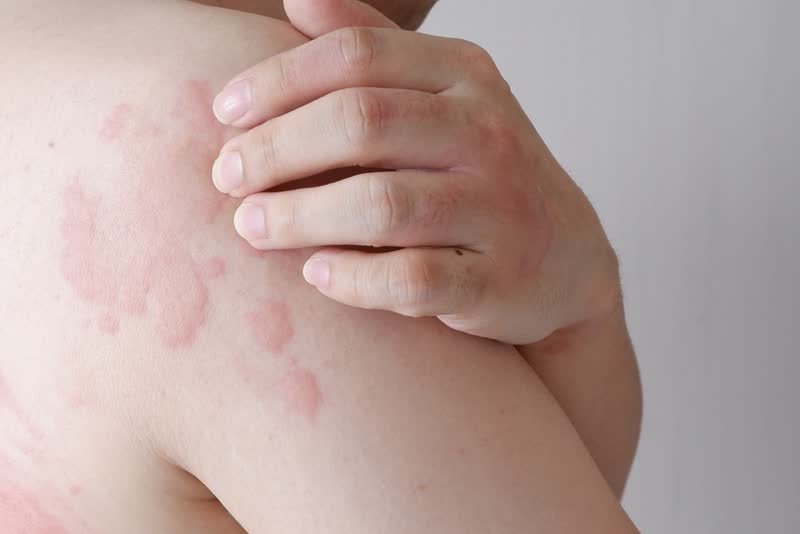 Perch&eacute; Ci Viene il Prurito?