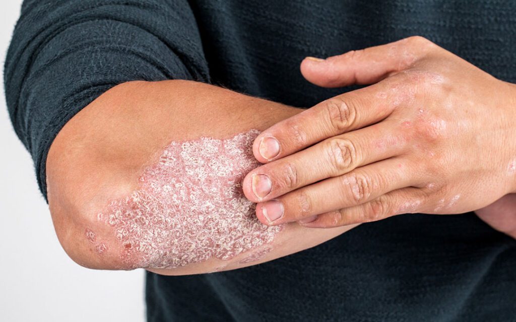 Qual &egrave; il motivo per cui viene la psoriasi?