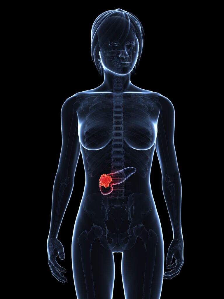 Chi è a rischio di tumore al pancreas?