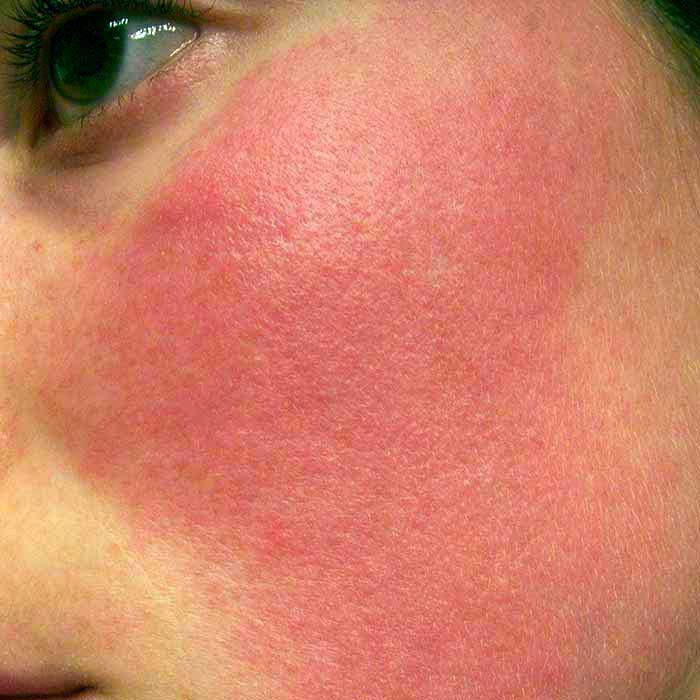 A cosa si deve il rossore delle guance?