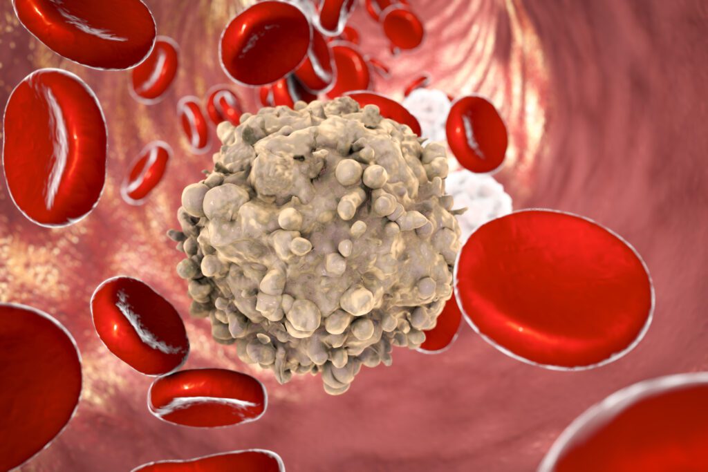 Quanto si sopravvive con la leucemia?