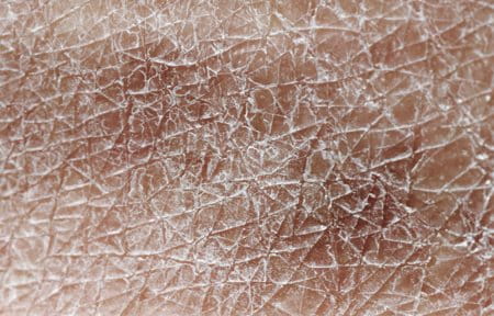 Che cos’è la xerosi cutanea?