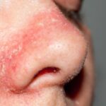 Cosa mettere sul naso screpolato dal raffreddore?