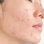 Cure dermatologiche per l'acne