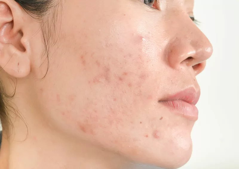 Cure dermatologiche per l'acne