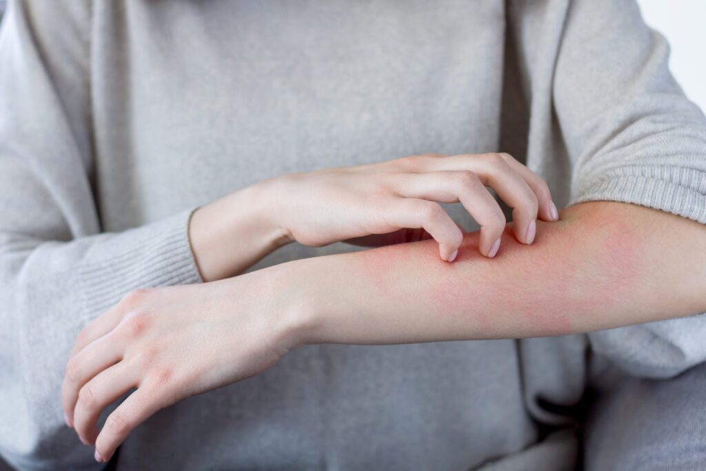 Alimenti che causano irritazione cutanea