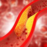 Arteriosclerosi e problemi di memoria