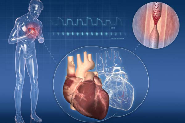 Quanto può vivere un cardiopatico?