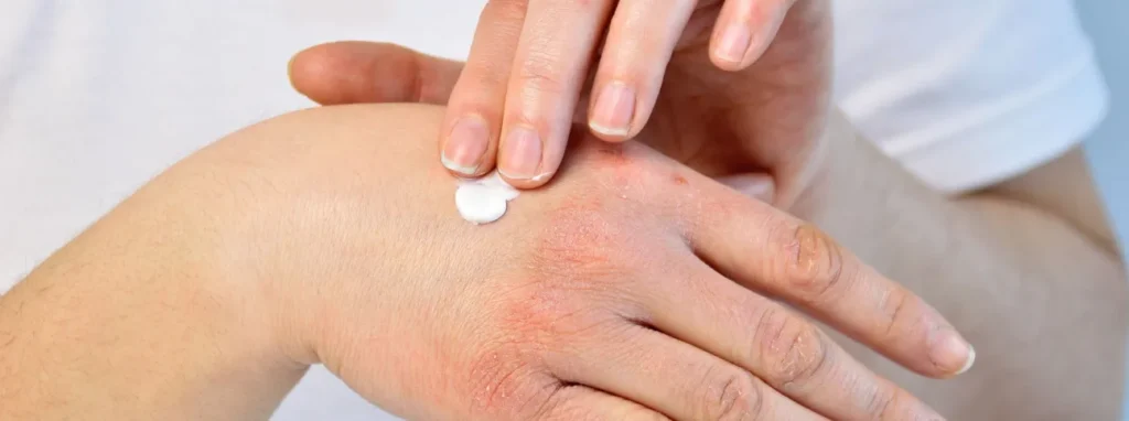 Trattamenti topici per la dermatite