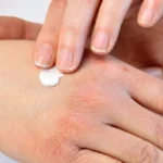 Trattamenti topici per la dermatite