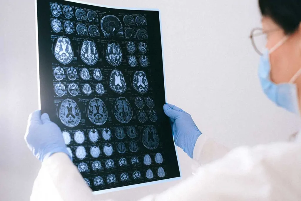 Chi è più predisposto all'Alzheimer?