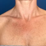 A cosa sono dovute le Macchie sul petto