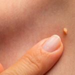 Cosa succede se si ha il papilloma?
