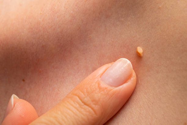 Cosa succede se si ha il papilloma?