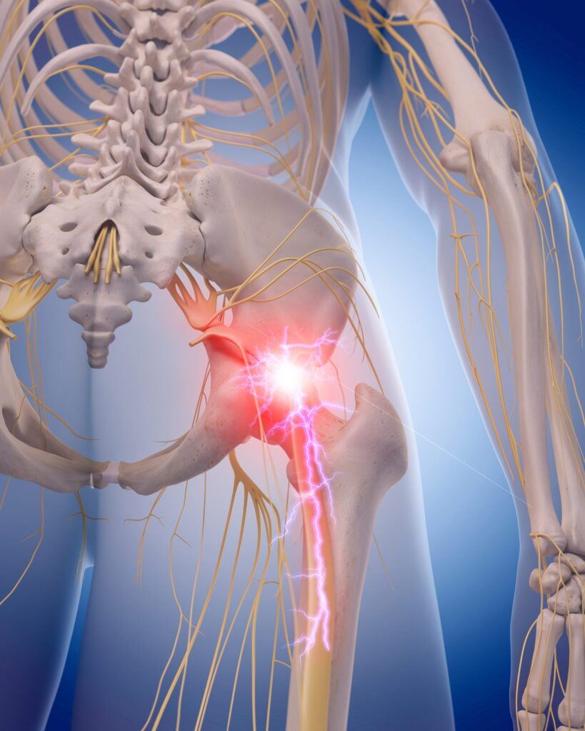 Come si fa a capire se si ha la sciatica?
