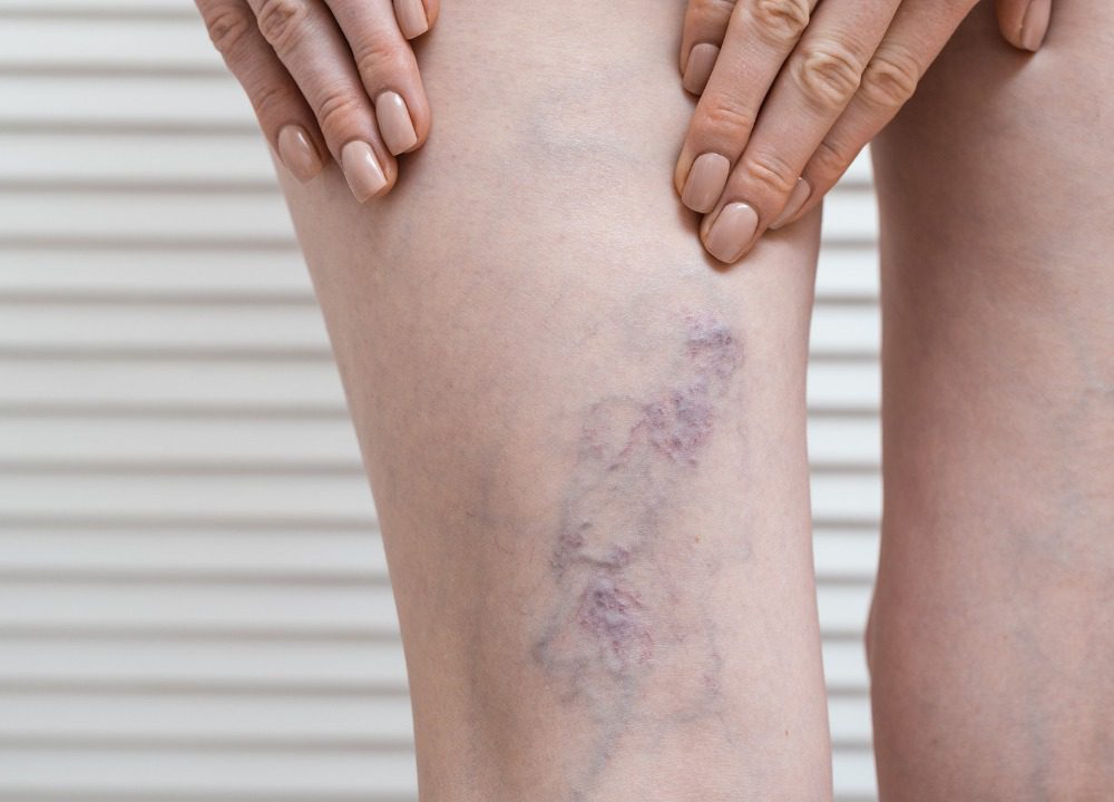 Quando le Vene Varicose Diventano Pericolose?