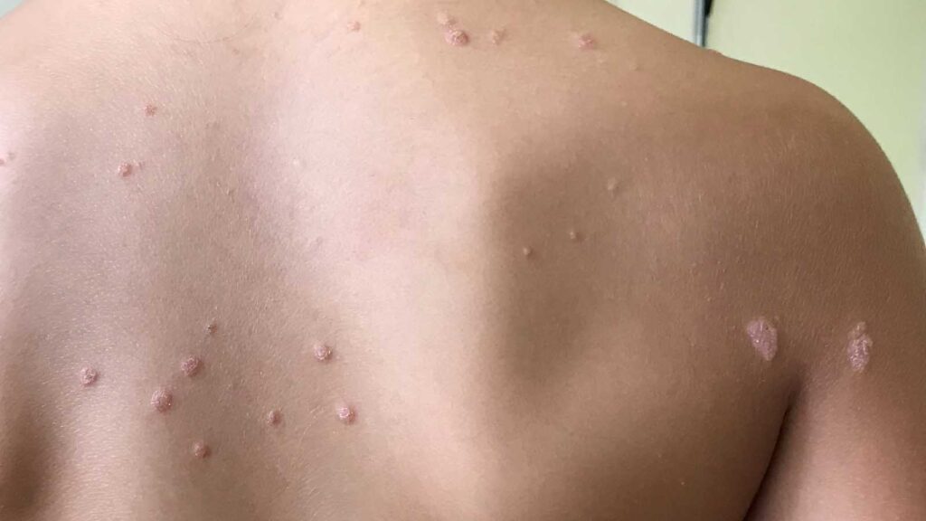 Psoriasi e Qualità della Vita