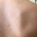 Psoriasi e Qualità della Vita