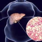 Sindrome Metabolica e Rischio Cardiaco