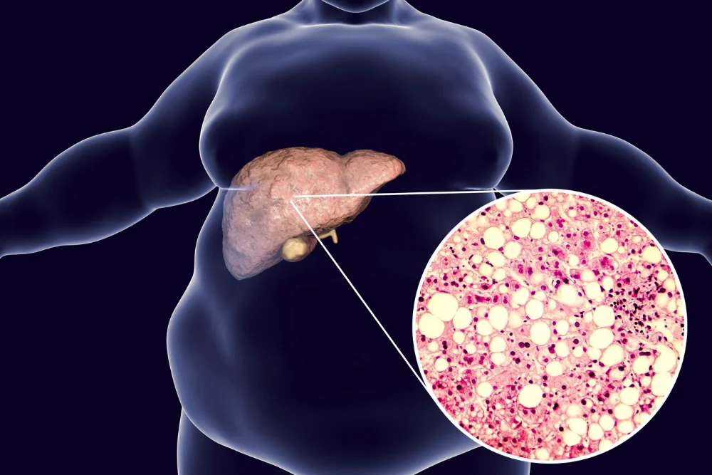Sindrome Metabolica e Rischio Cardiaco