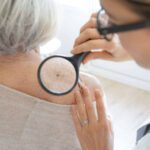 Prevenzione del melanoma e controllo della pelle